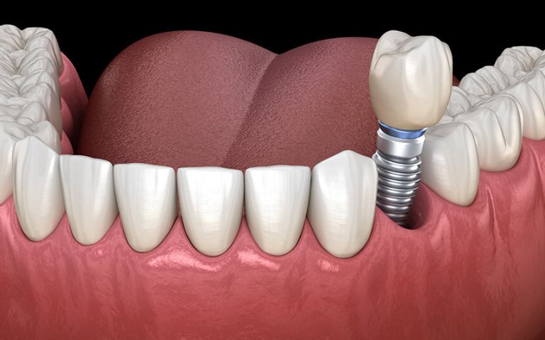 Dental implant illustration for senior tooth replacement in Huntington Beach