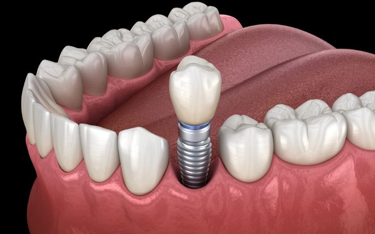 Cross-section view of a dental implant