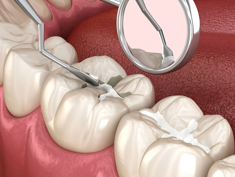 Dental sealant procedure in Huntington Beach