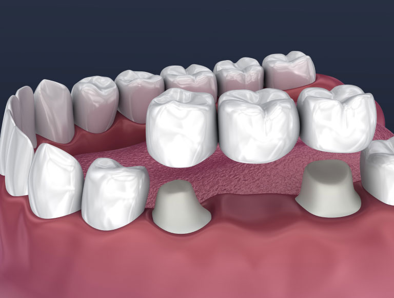 a dental bridge supported by two crowns