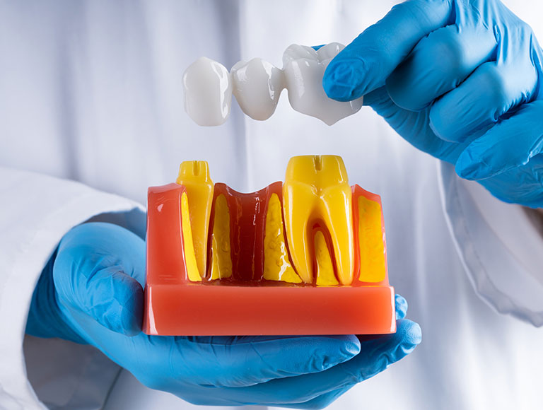 Dentist holding a model showing a dental bridge over prepared teeth