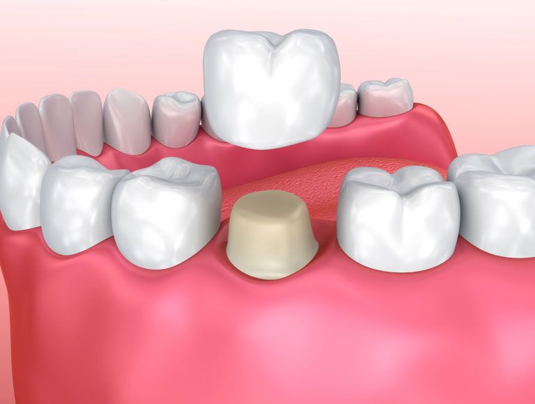 dental crowns in huntington beach ca