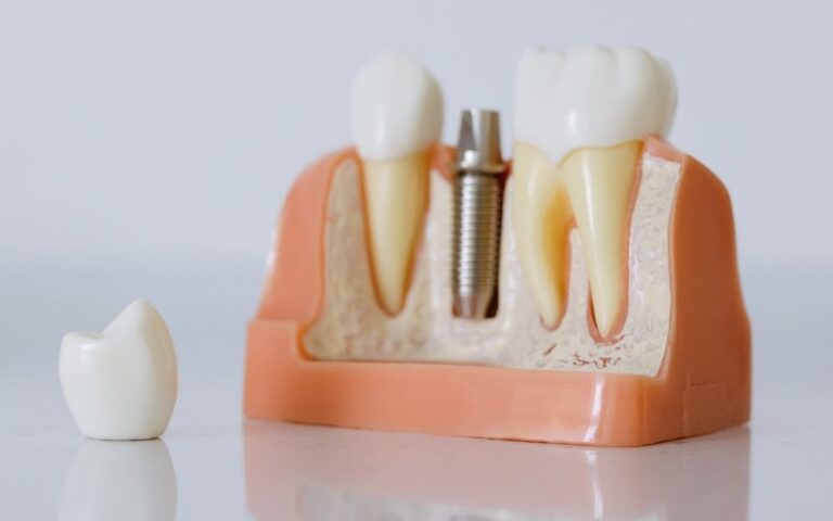 Model showing proper placement of a dental implant for oral care guidance