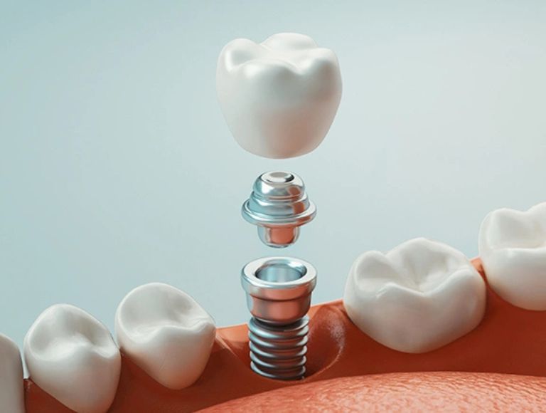 Dental implants in Huntington Beach, CA