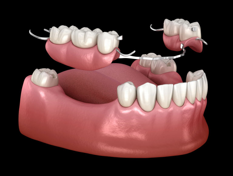 dentures treatment in huntington beach ca