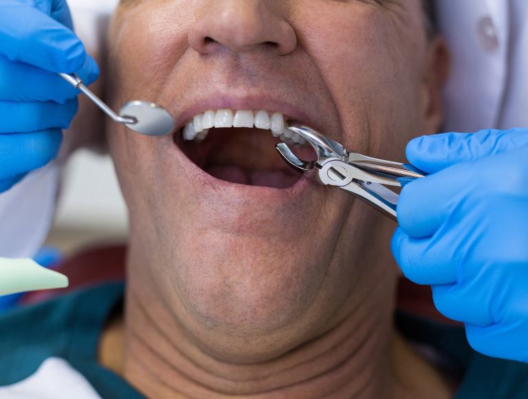 patient receiving tooth extraction treatment in huntington beach