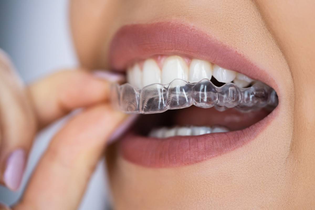 featured image for how do clear dental aligners work